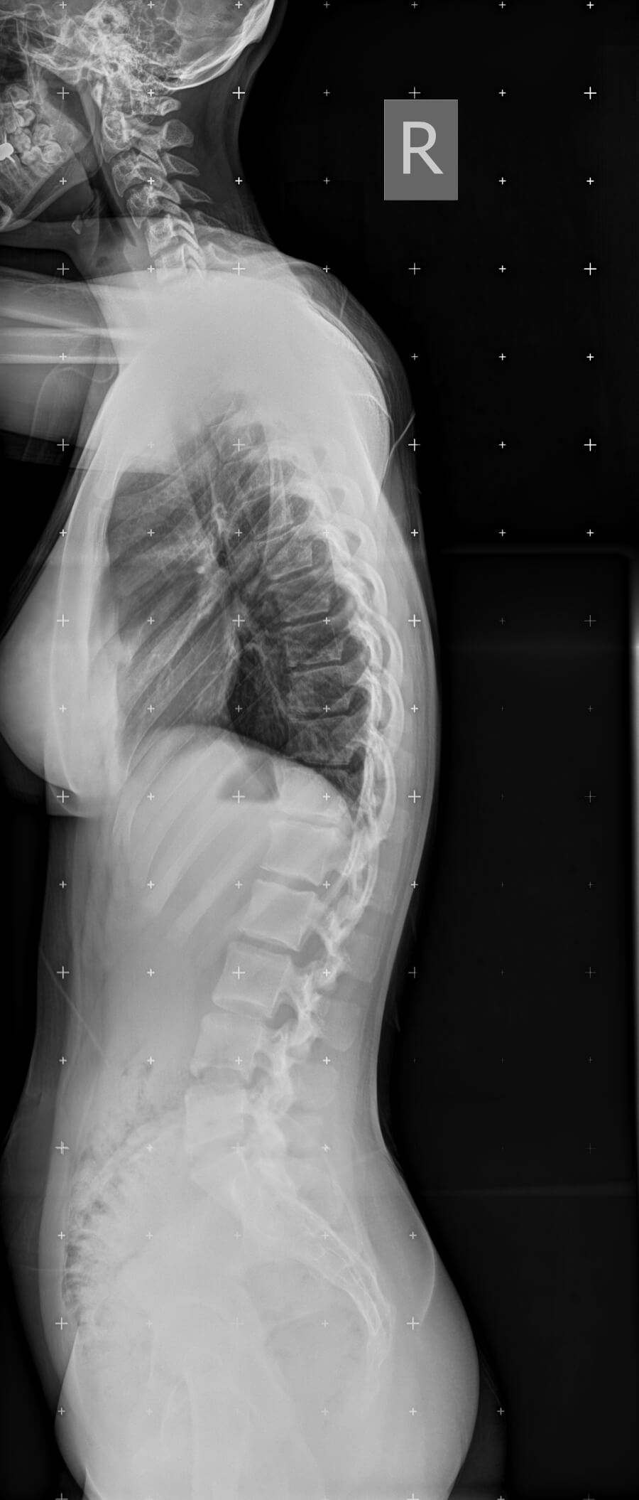 цифровий рентген хребта